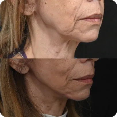 Deep Plane Facelift — resultado