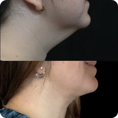 Lipectomía Cervical — resultado