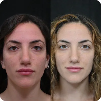 Cirugía de la mirada — resultado