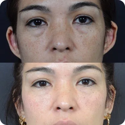 Otoplastia — resultado